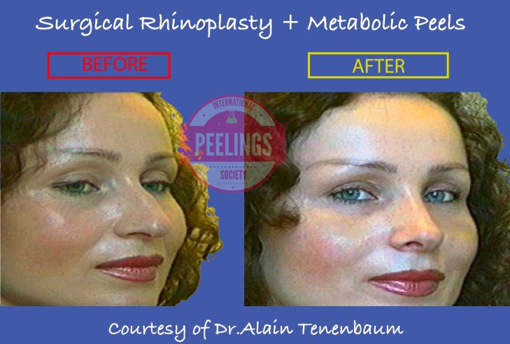 surgical-rhinoplasty 3/4 + metabolic-peels.