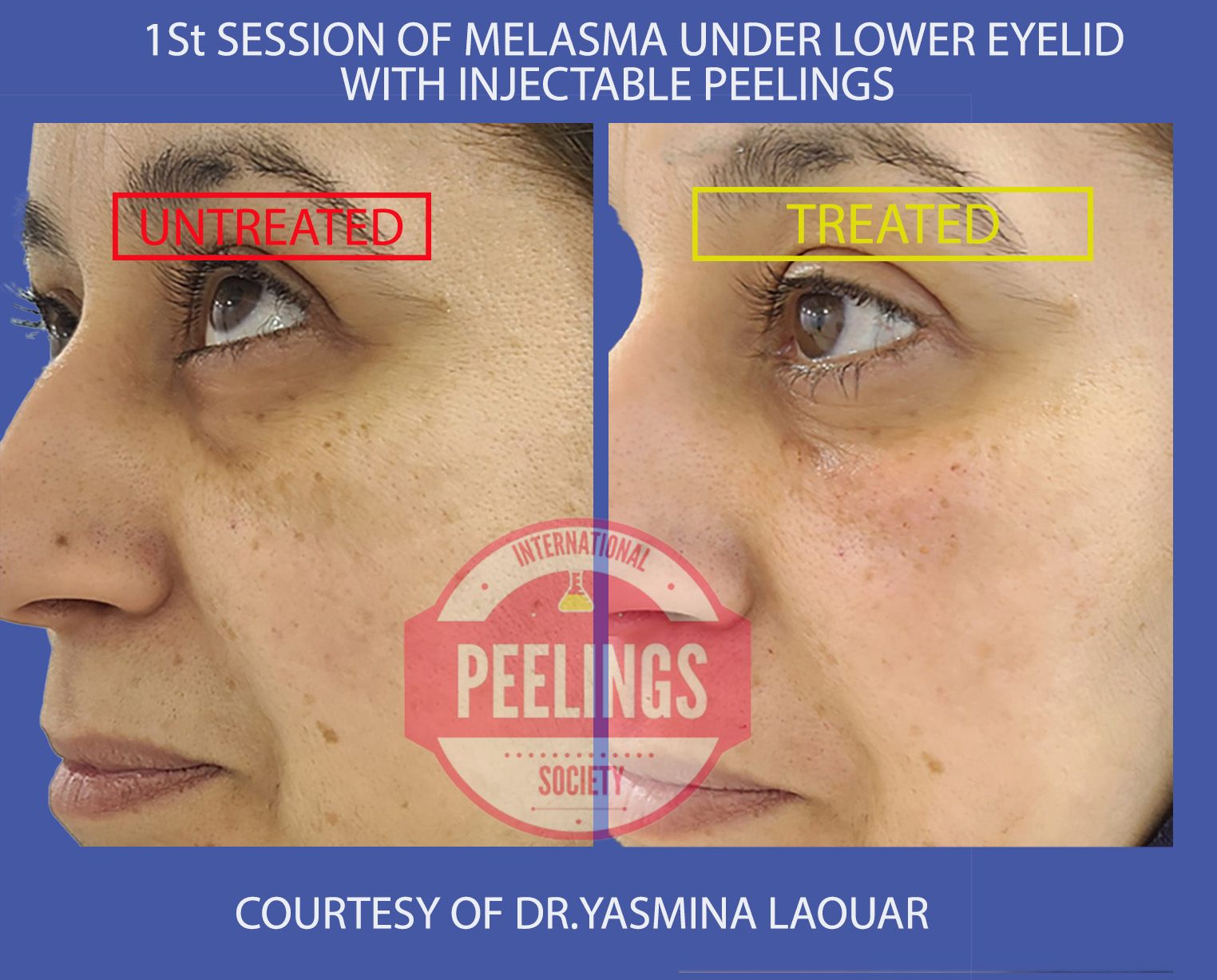 hyperchromies/melasma-poc-L1