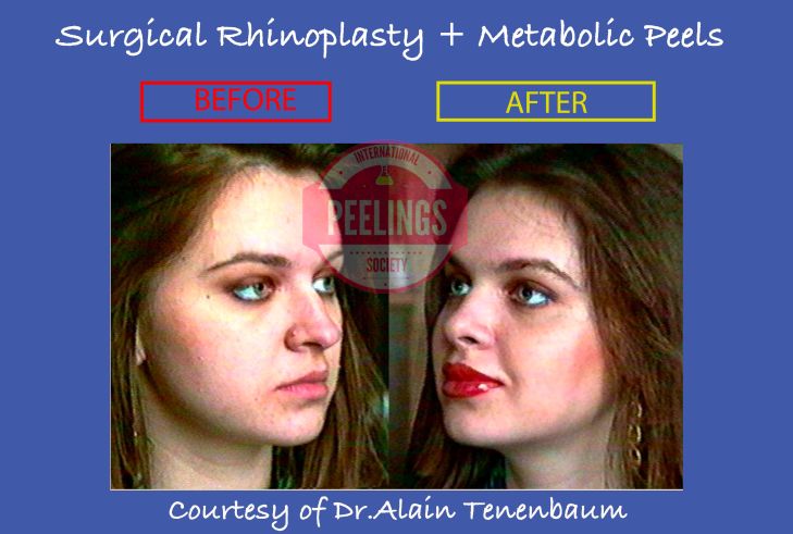 rhinoplasty-metabolic-peels