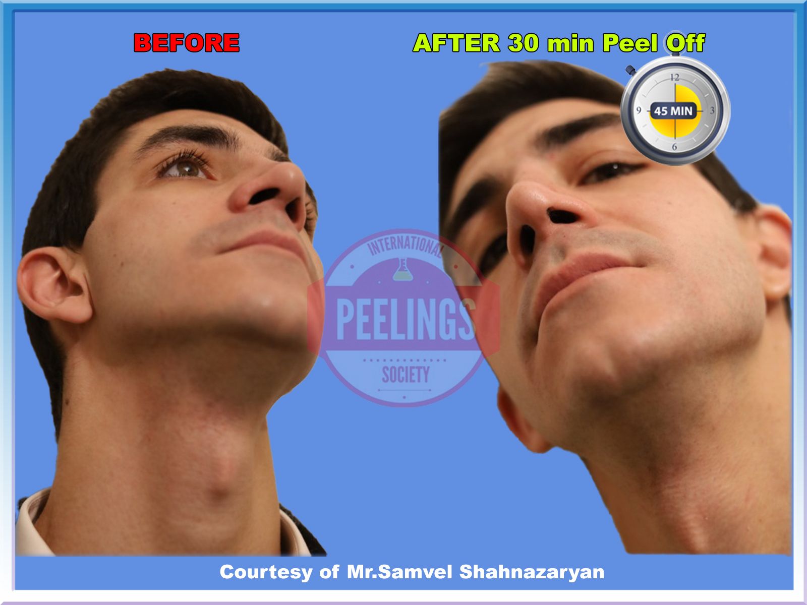 smokers-skin-treatment-pic4