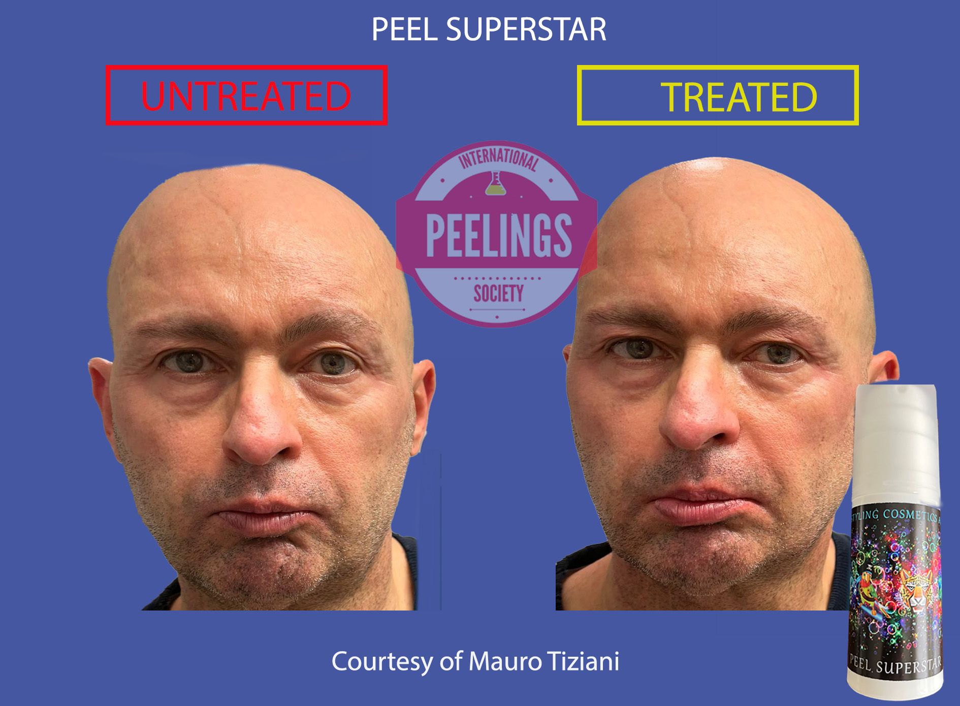 peel-superstar-result-after 24h