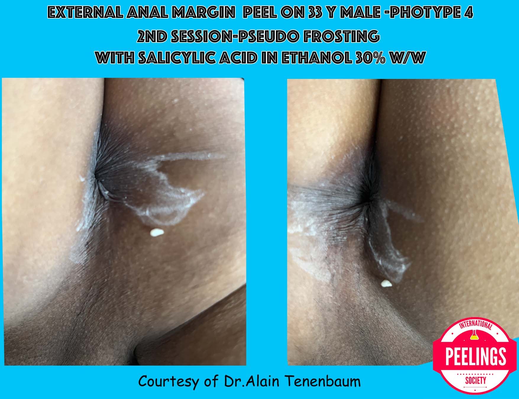 pseudo-frosting with salicylic acid in ethanol 