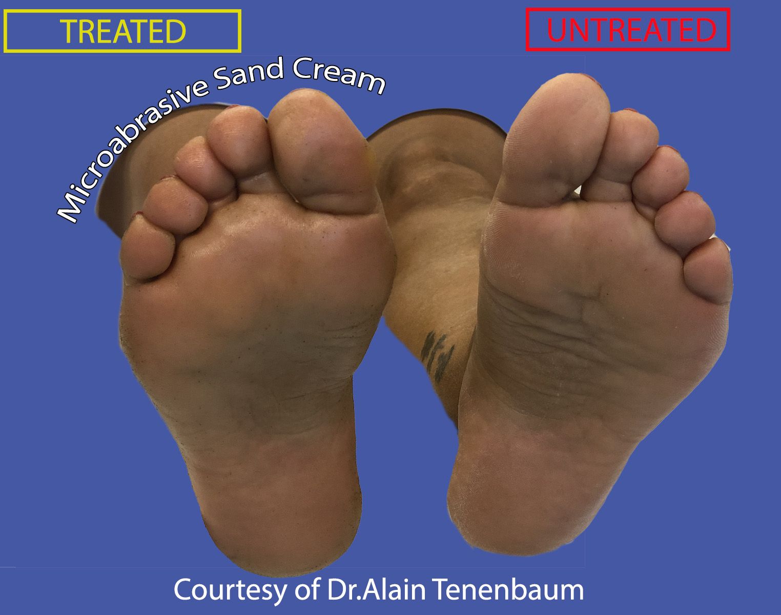 cracks-feet-microabrasive