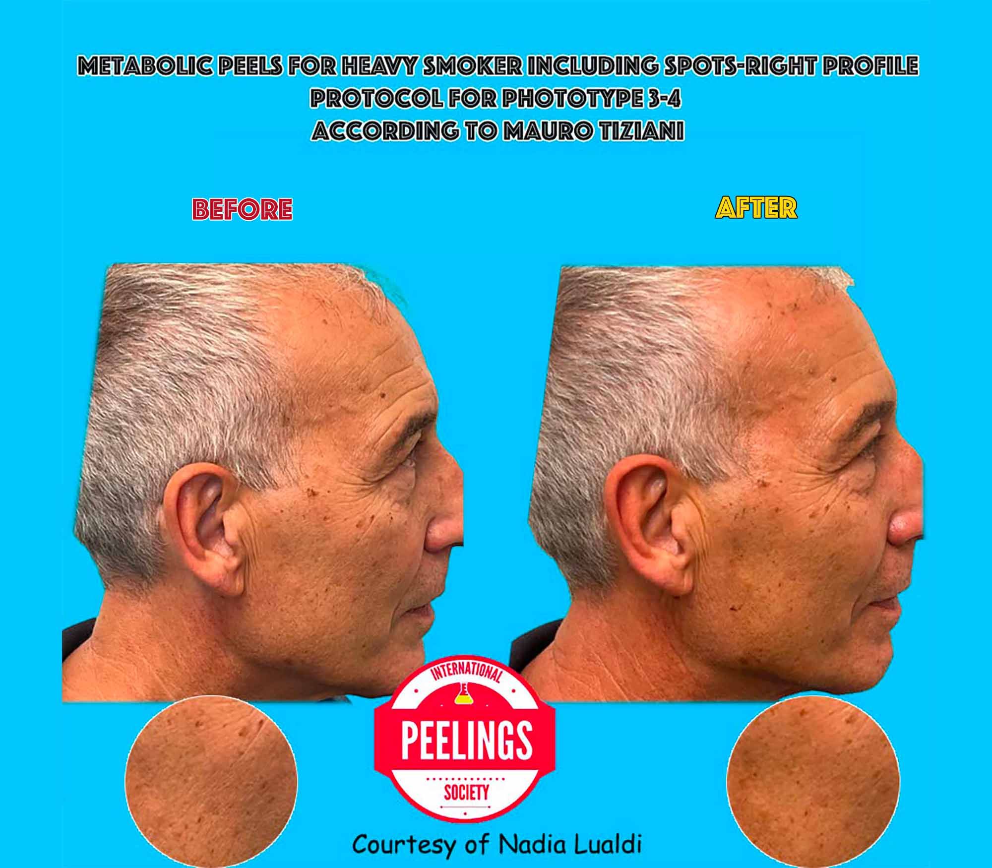 smokers skin metabolic peels side pic