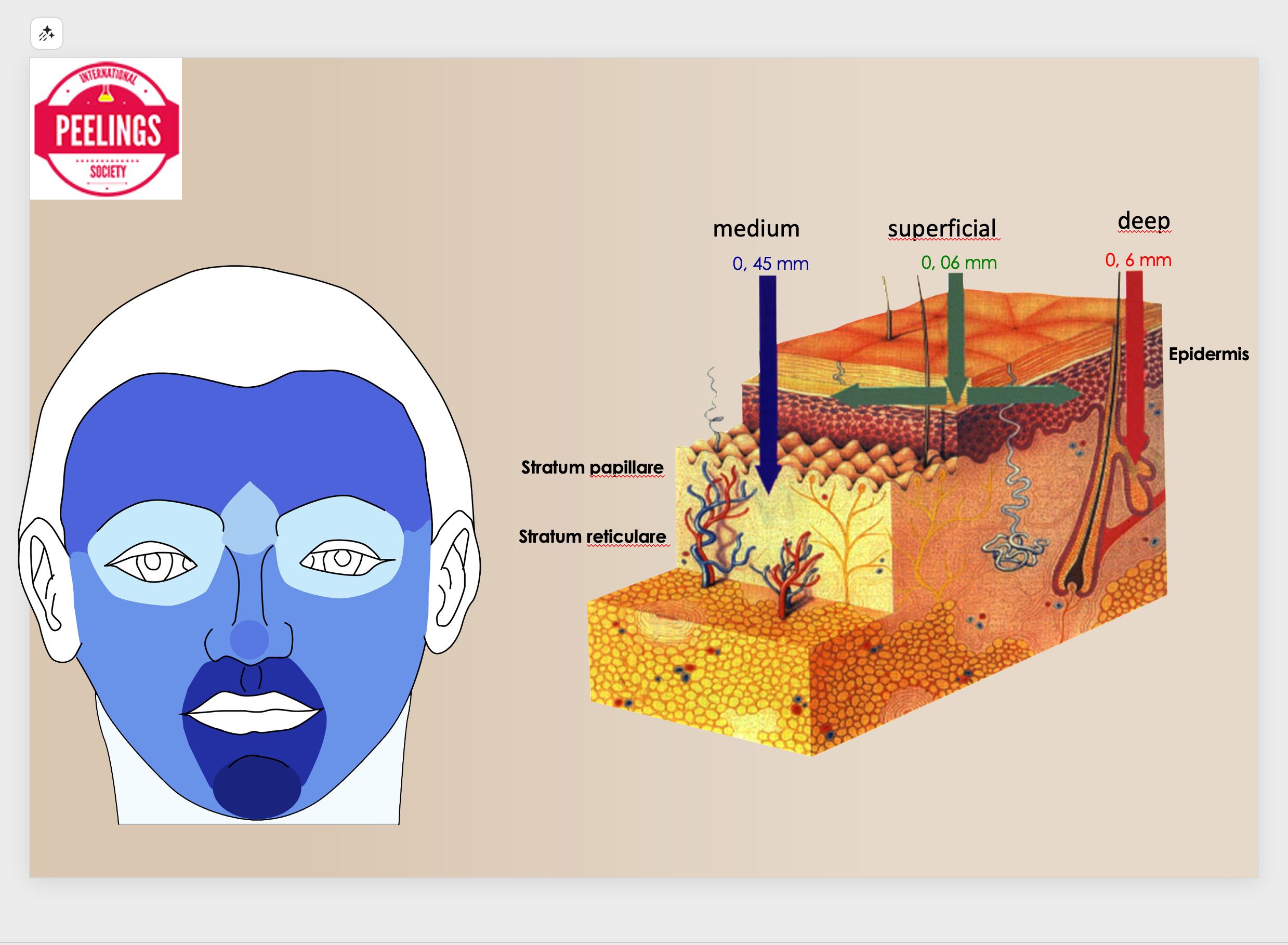 TCA chemical peel penetration depth diagram showing superficial medium and deep action