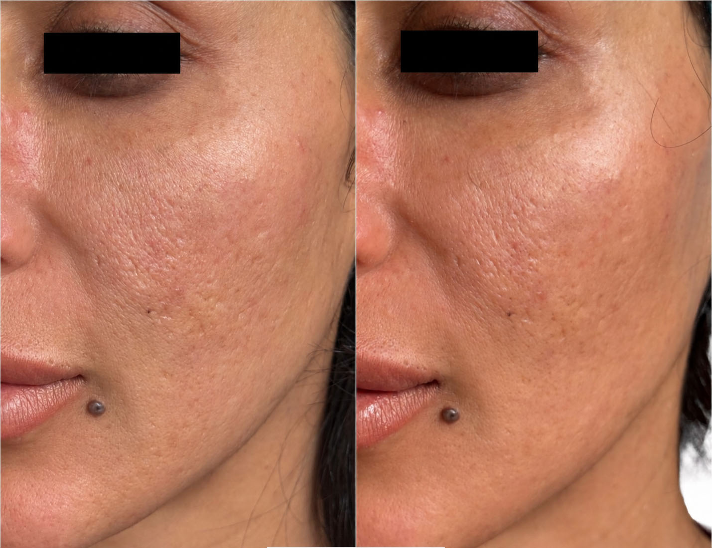 Left facial side before and immediately after one 30 Min Peel Off session in a patient with post-acne atrophic scars