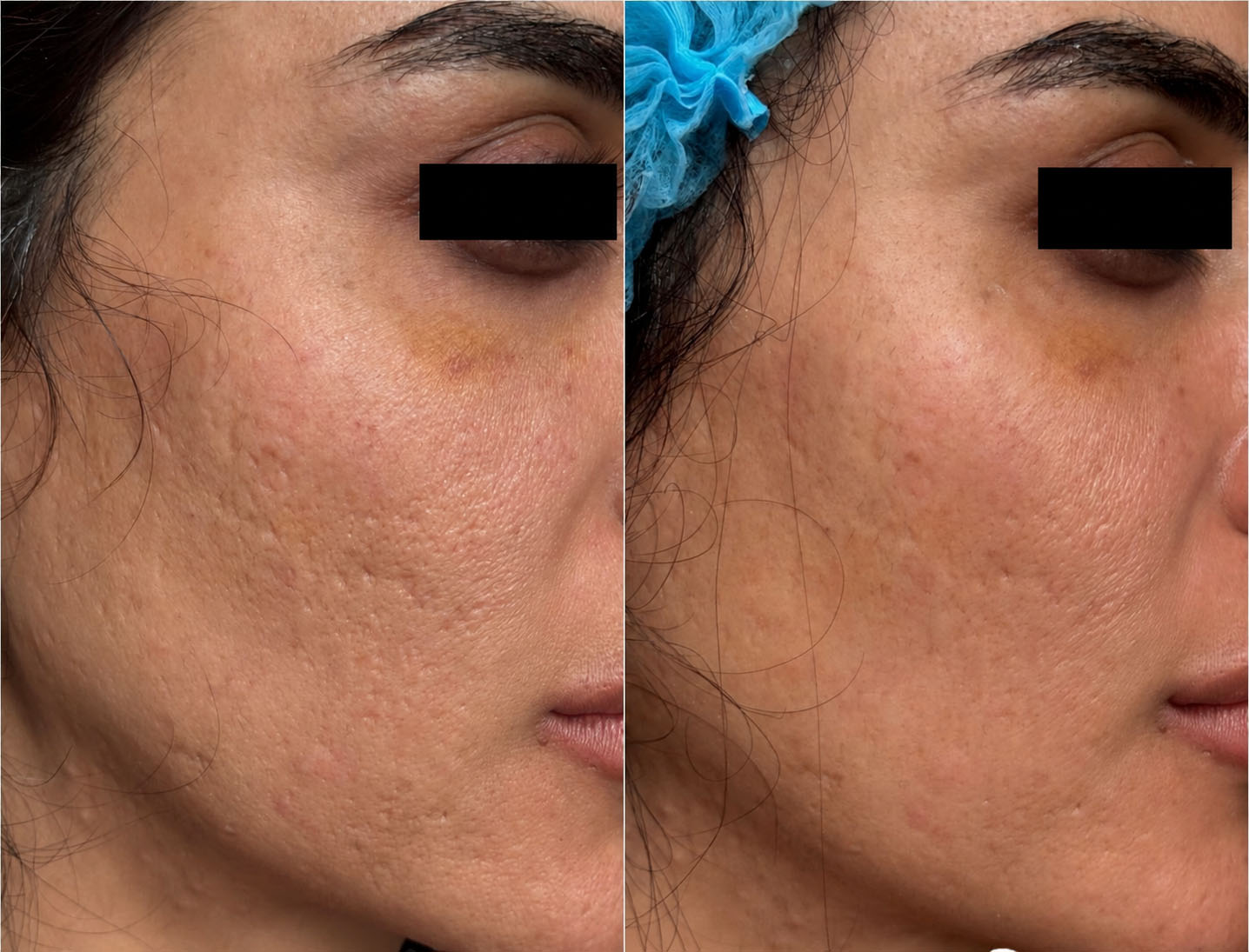 Right facial side before and immediately after one 30 Min Peel Off session in a patient with post-acne atrophic scars