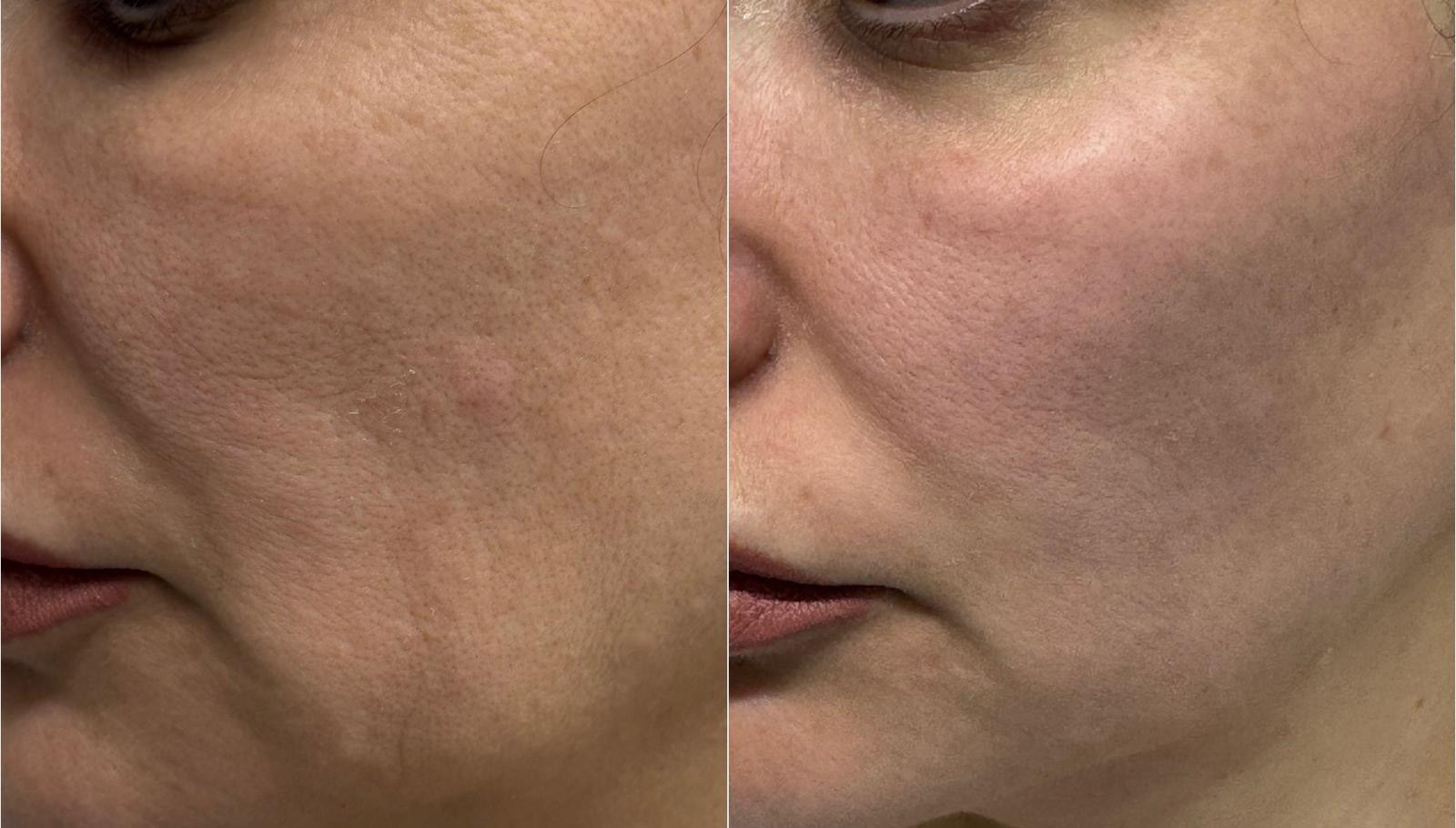 Left facial side before and immediately after one 30 Min Peel Off session — clinical case courtesy of Dr George Titovets