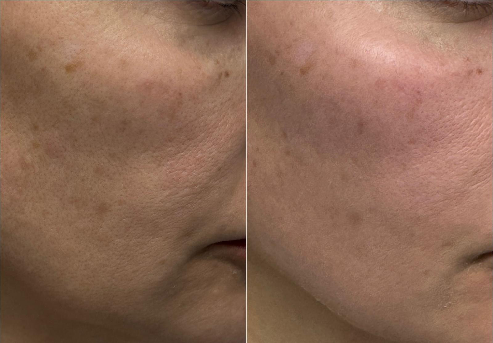 Right facial side before and immediately after one 30 Min Peel Off session — clinical case courtesy of Dr George Titovets