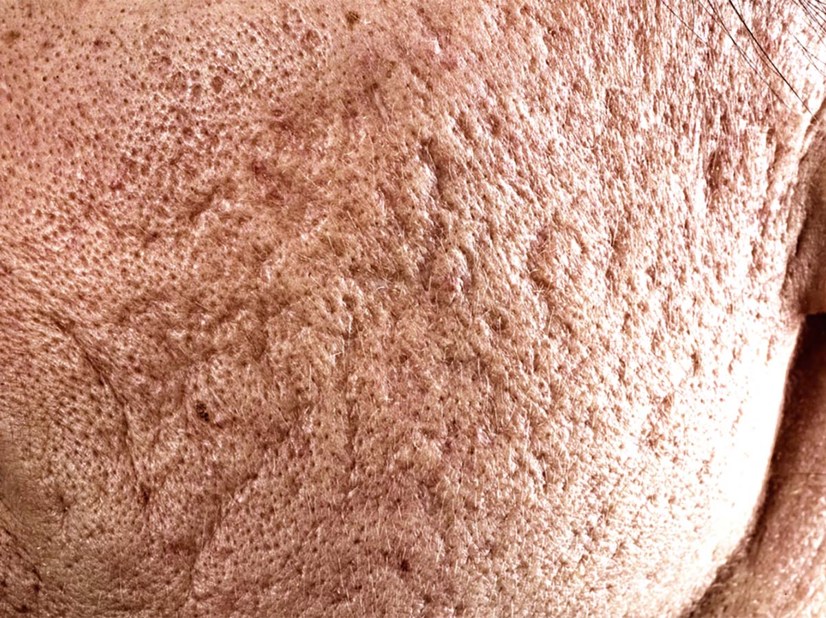Deep post-acne scarring with mixed atrophic patterns; clinical texture contrast typical after inflammatory acne