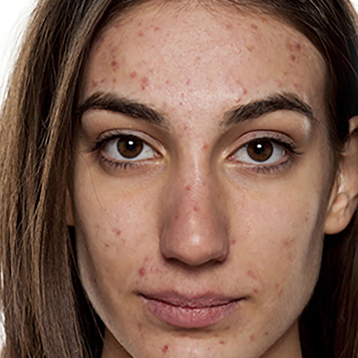 juvenile acne inflammatory papules and comedones on adolescent face