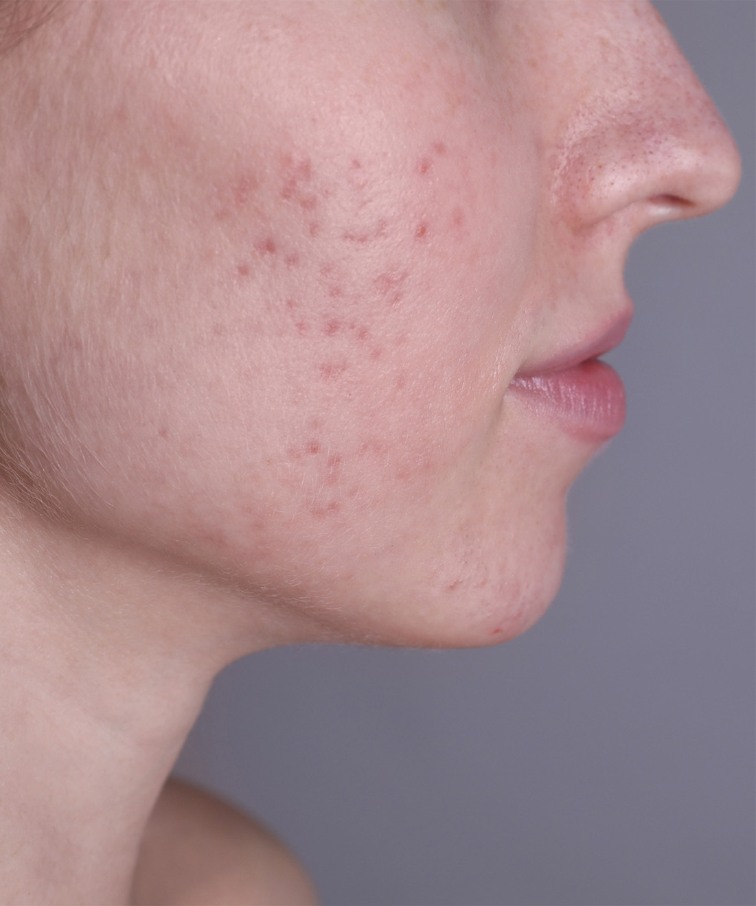 Persistent adult acne showing inflammatory papules and microcystic lesions on the lower face in an adult patient
