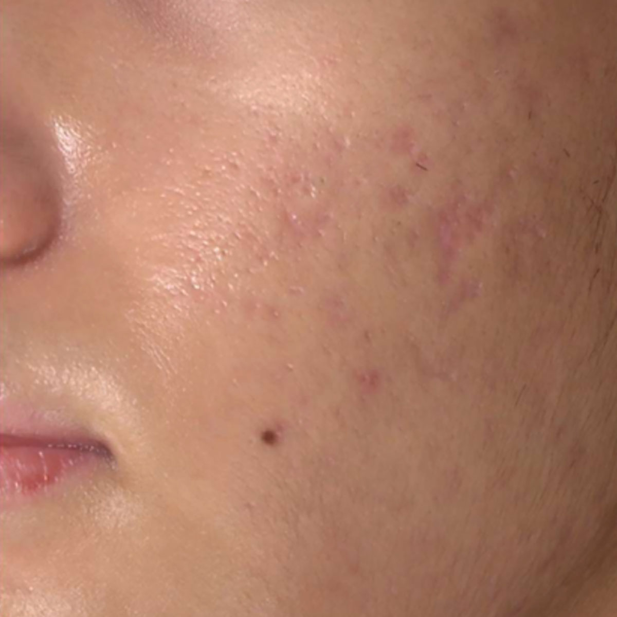 post acne scars and post inflammatory erythema on cheek