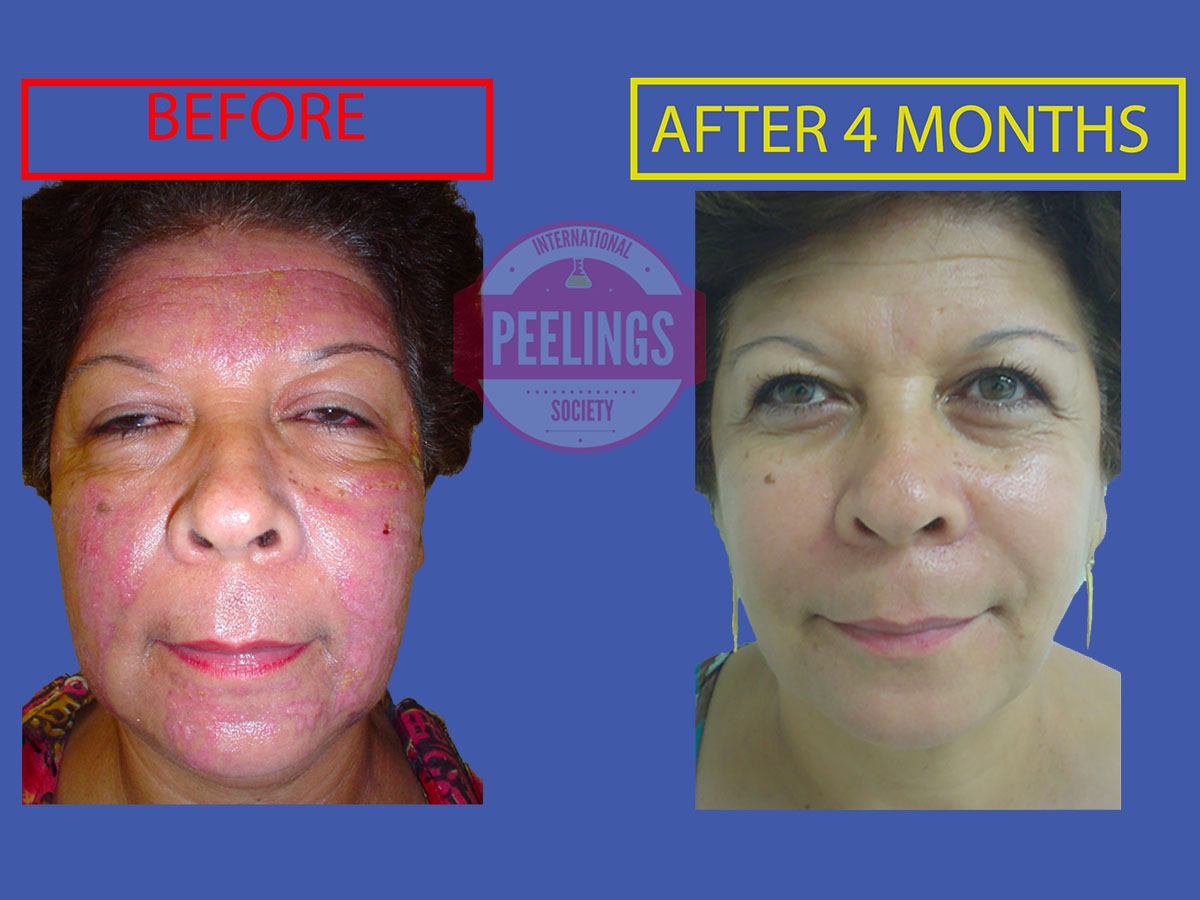 post peel hyperpigmentation correction metabolic protocol