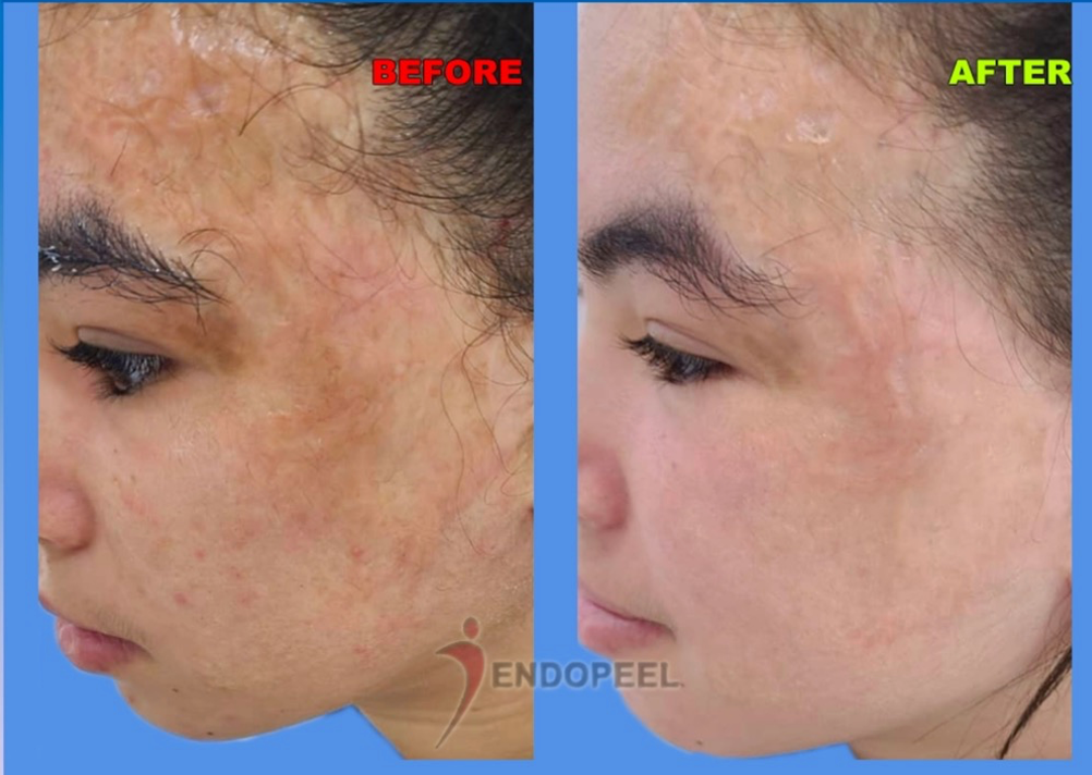 Facial sequelae of burns clinical topic