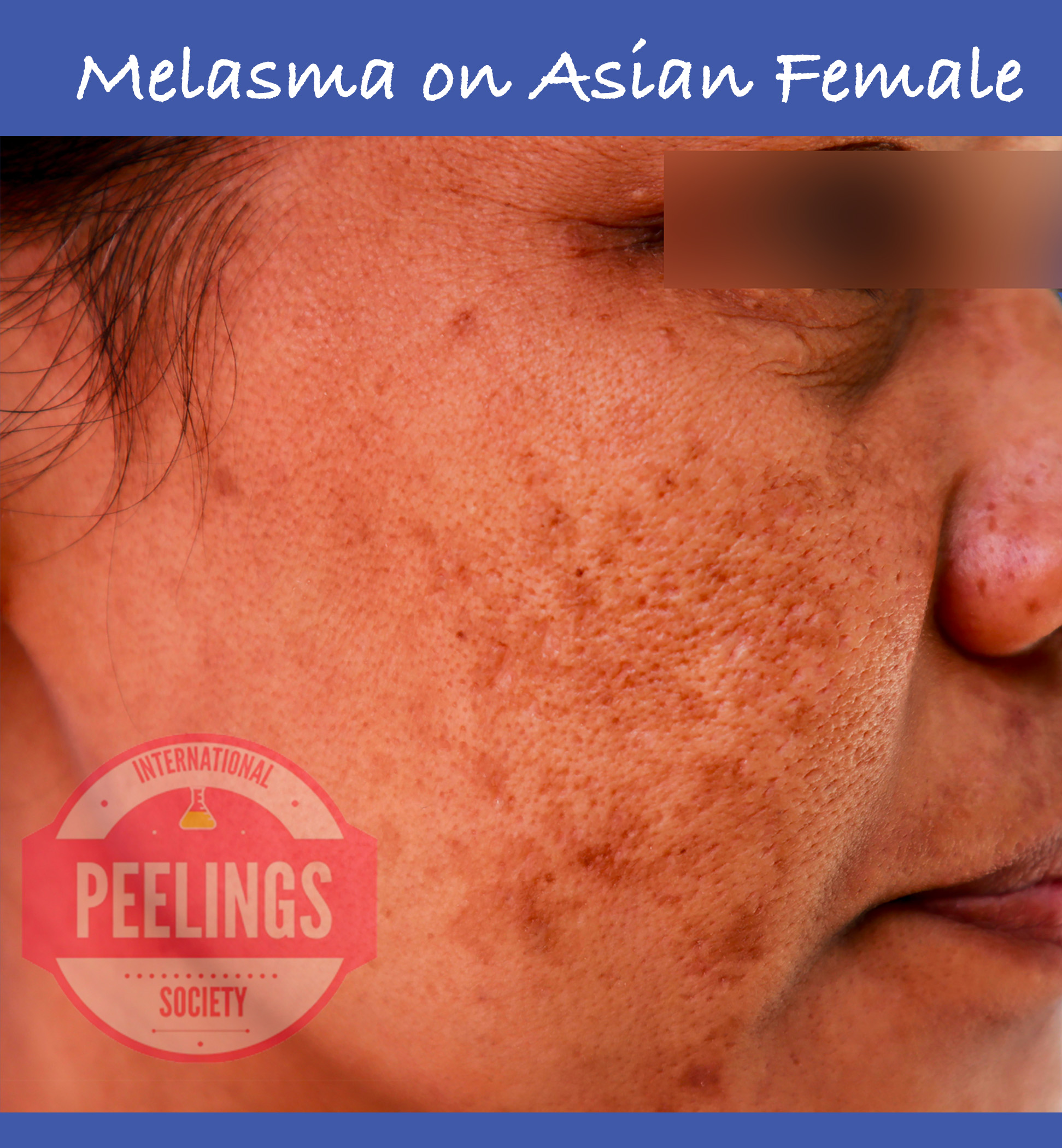 clinical aspect of melasma on asian female
