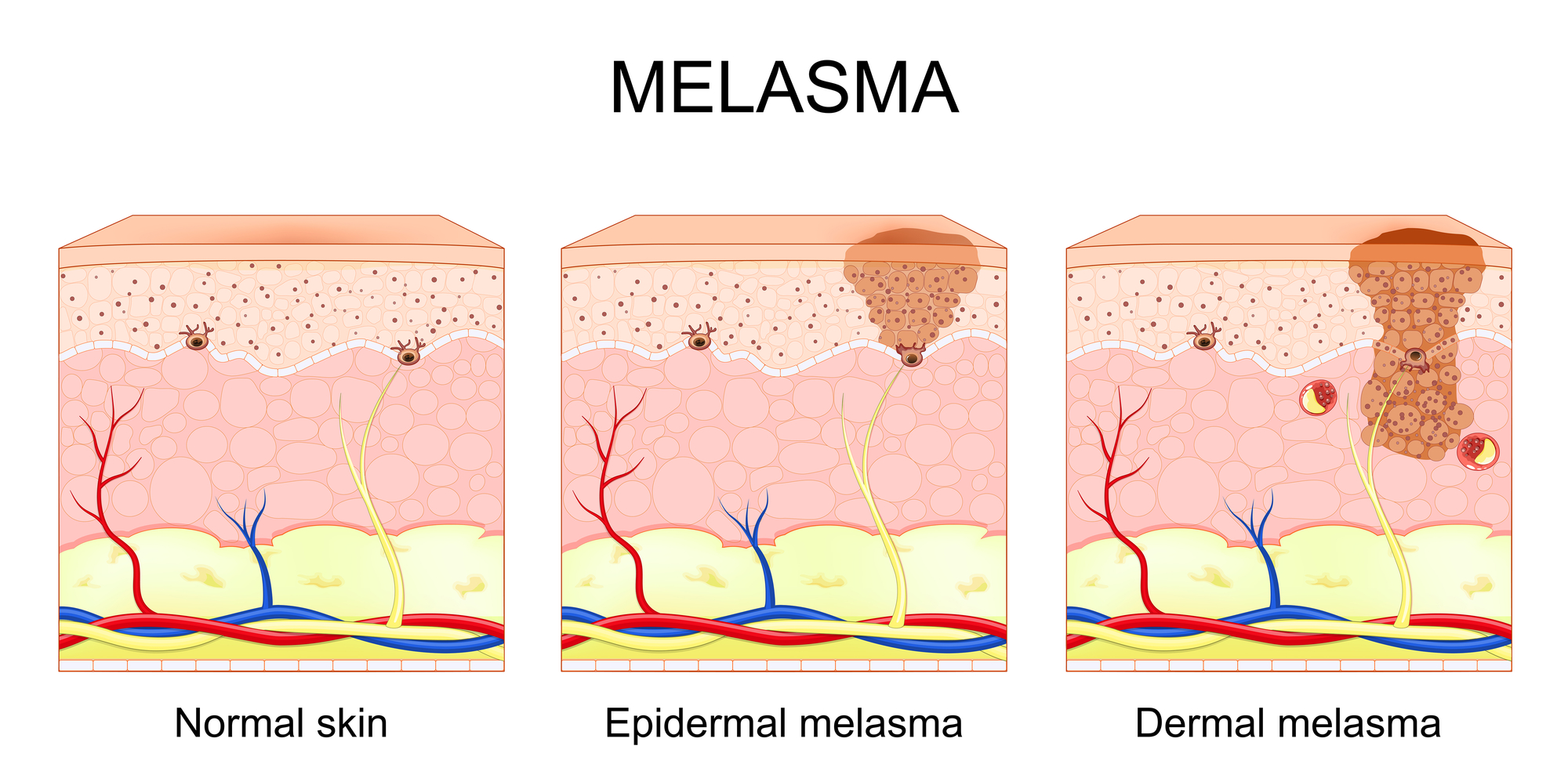 Epidermal & Dermal Melasma