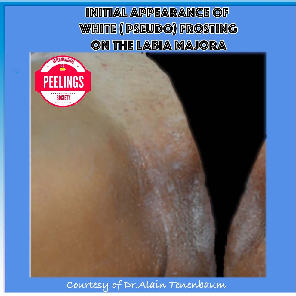 Initial appearance of white pseudo-frosting on external labia majora skin during an intimate peeling procedure