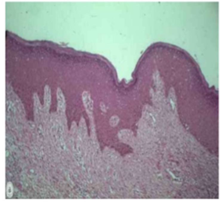 Histological appearance of vulvar vestibular tissue