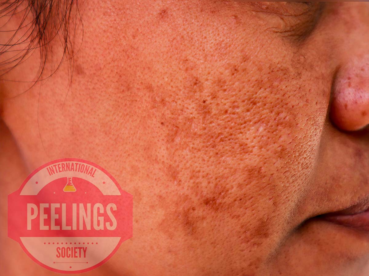 facial melasma hyperpigmentation patches on cheek and forehead