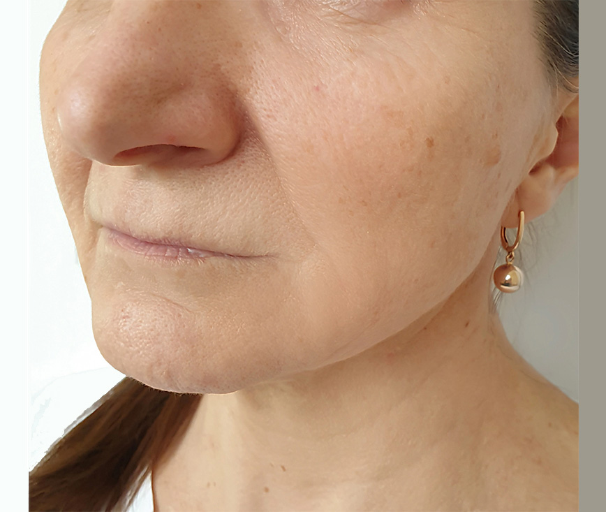 After chemical peel protocol for photoaging