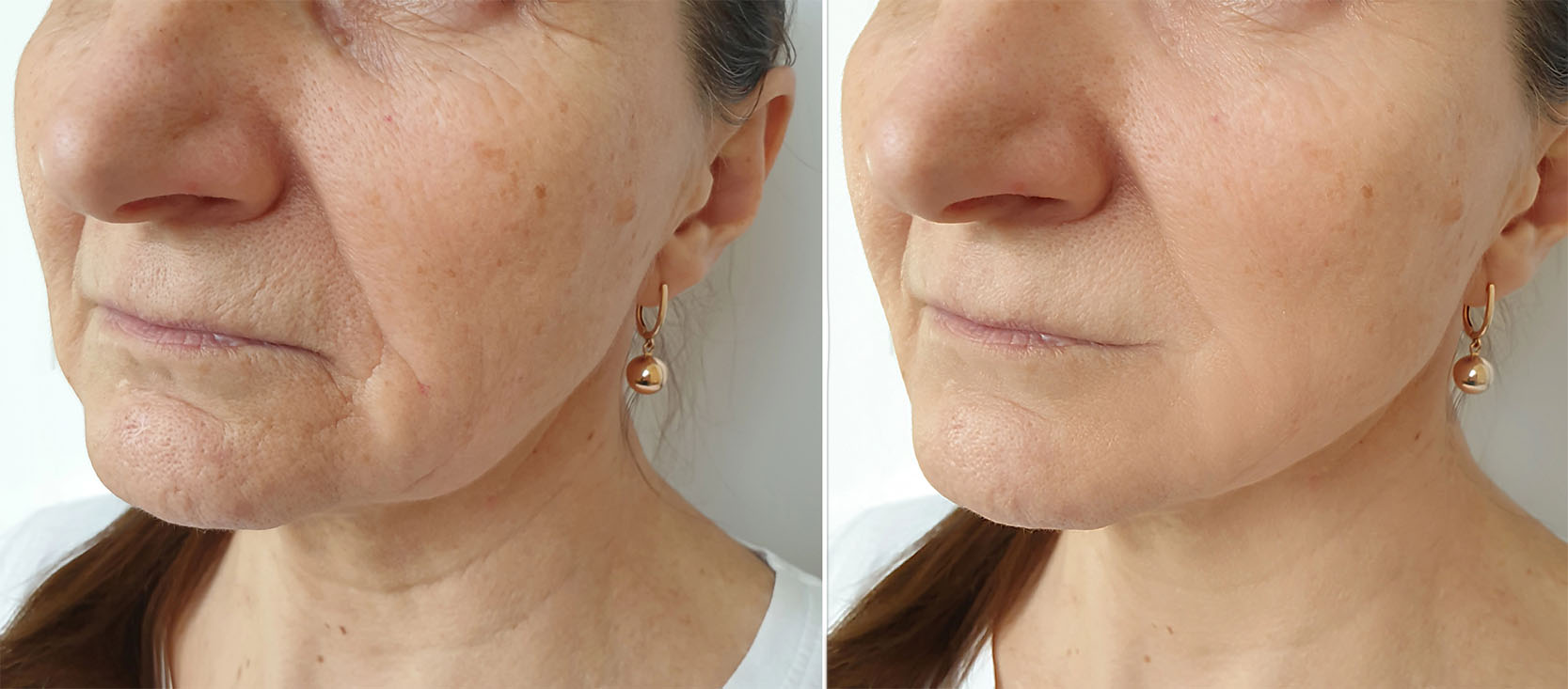 Before and after chemical peel results for photoaging
