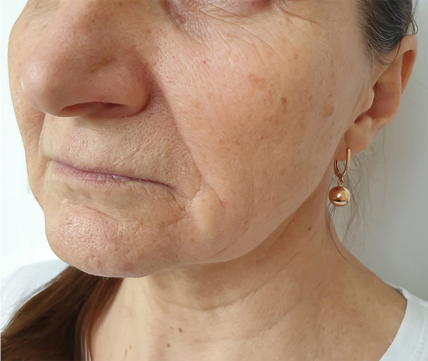Before chemical peel protocol for photoaging