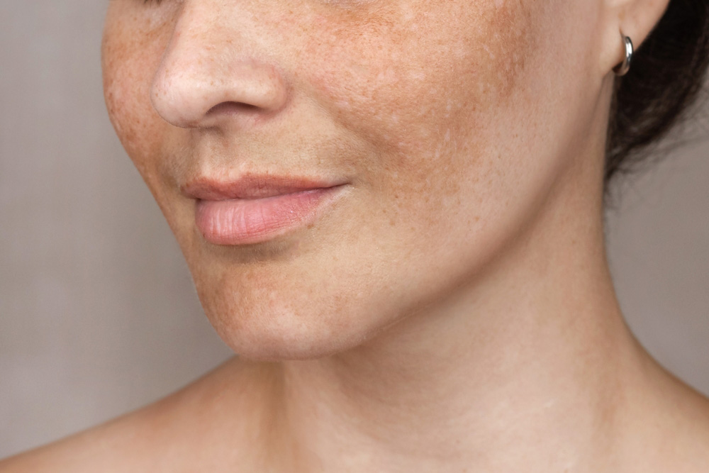 Photoaged facial skin showing lentigines, uneven pigmentation, and textural irregularities caused by chronic sun exposure