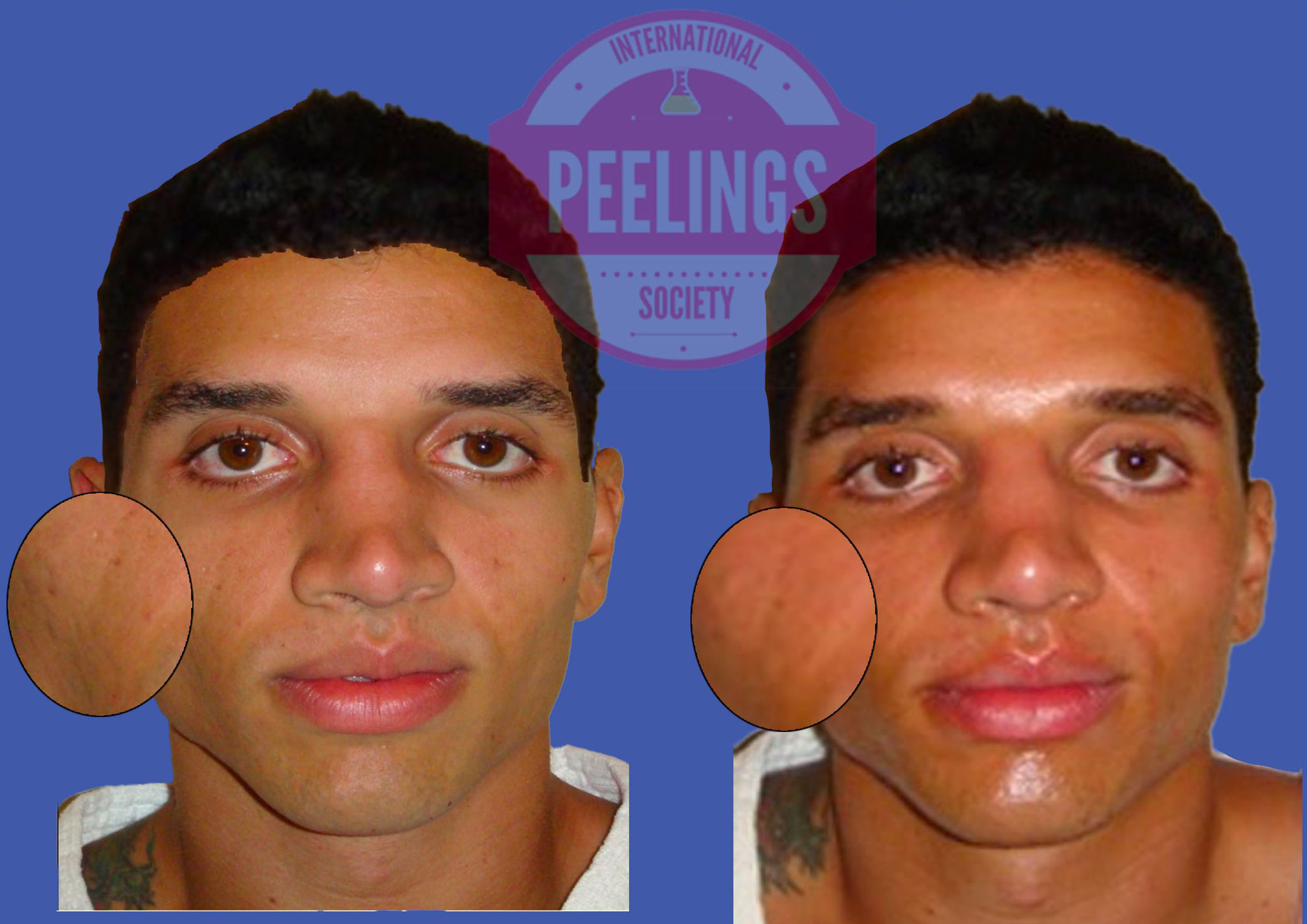 Before and after chemical peel results in skin of color showing improved tone uniformity and reduced pigmentation irregularities