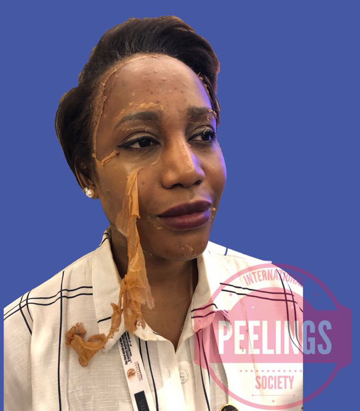 Melanin-rich skin in clinical aesthetic context