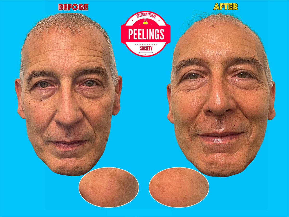 smoker related facial skin changes with dull tone surface fatigue and spots