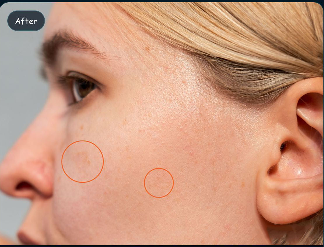 After treatment placeholder for facial solar lentigines improvement