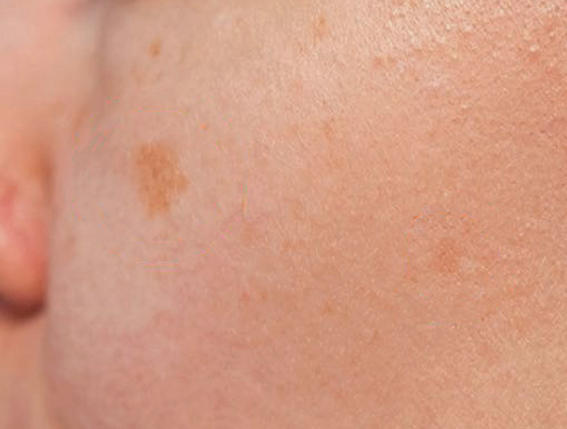 Solar lentigines on photoexposed cheek showing well-defined hyperpigmented macules