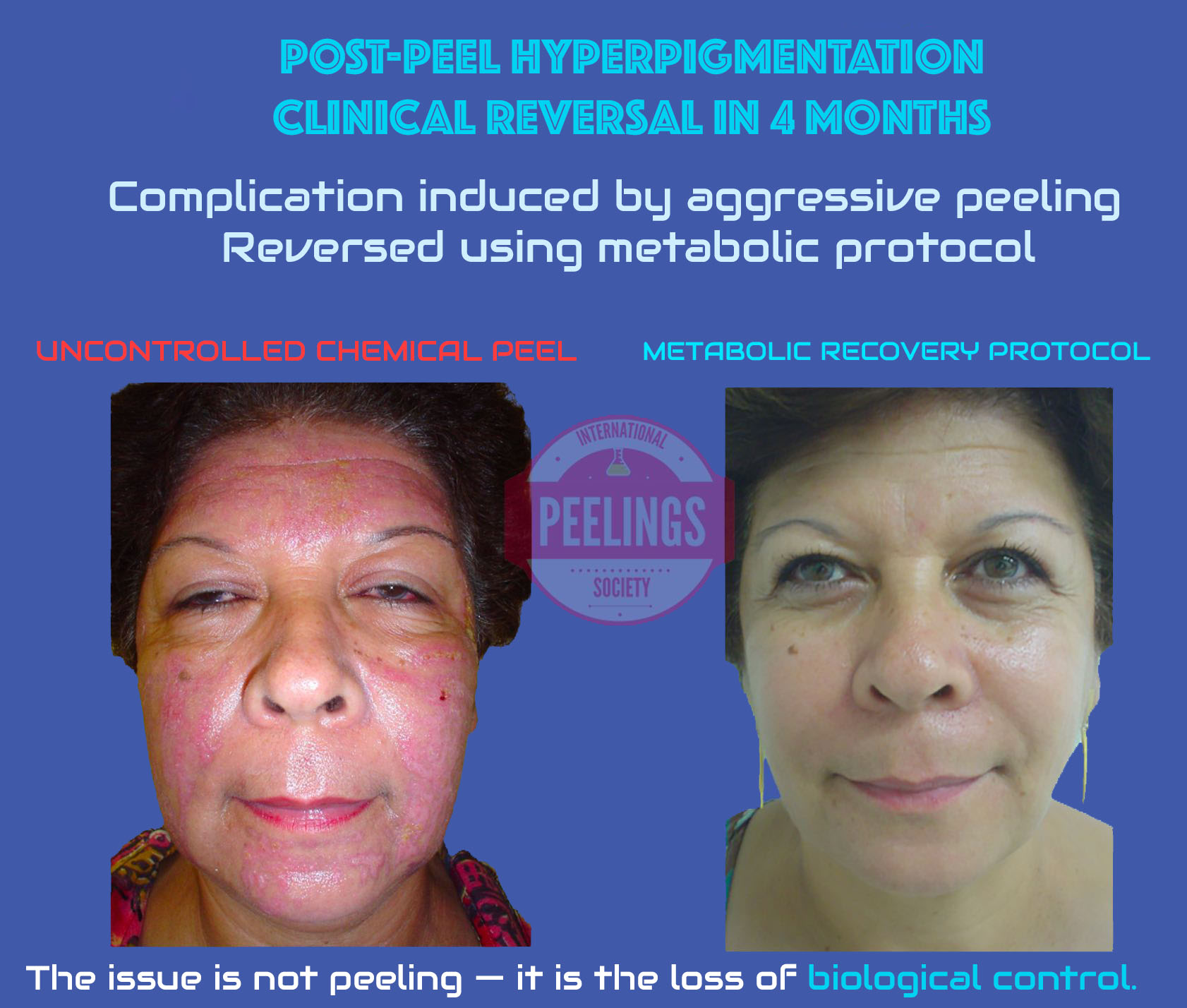 Post peel hyperpigmentation reversed using metabolic protocol