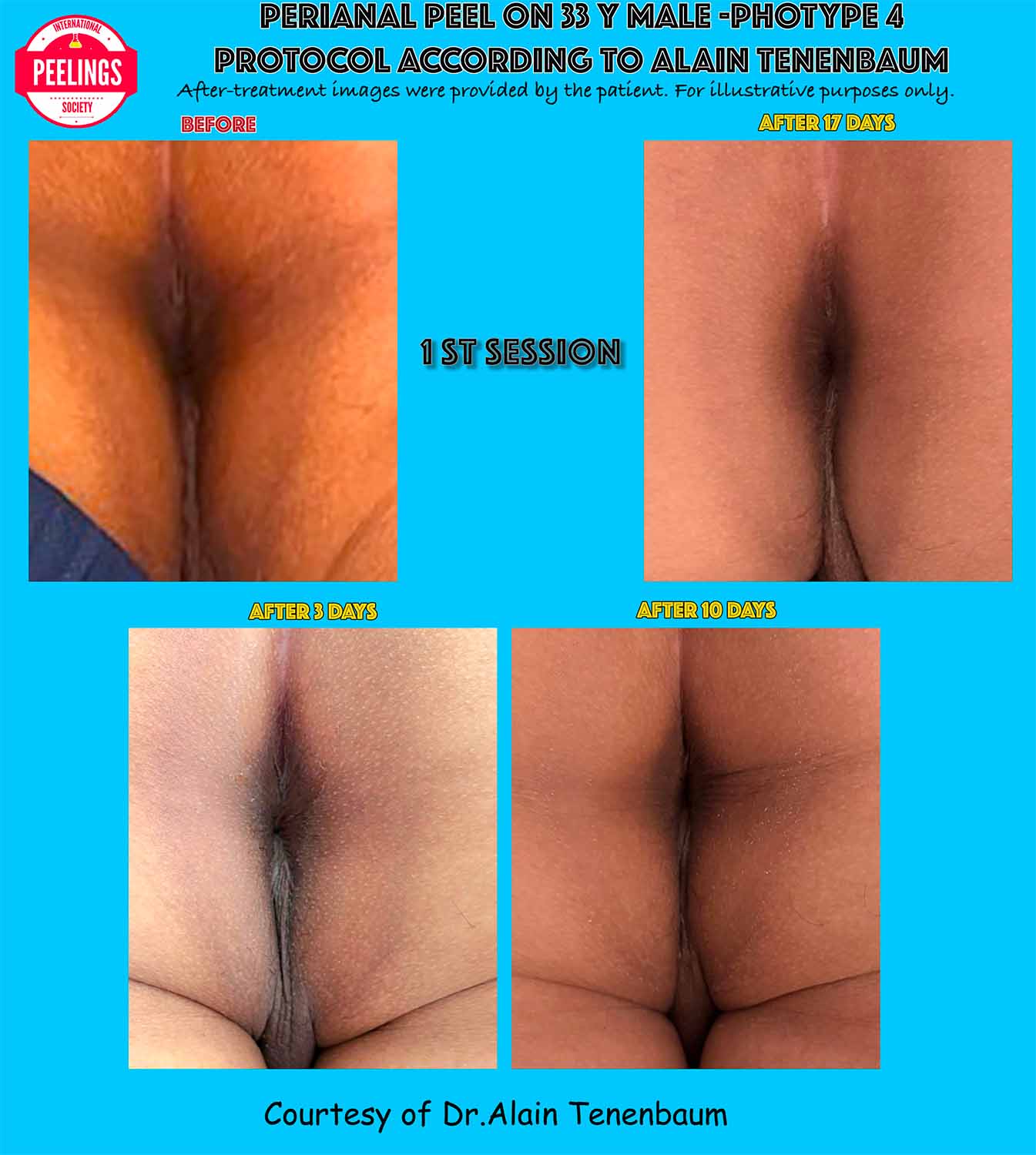 Clinical evolution from day 0 to day 17 after the first perianal peeling session