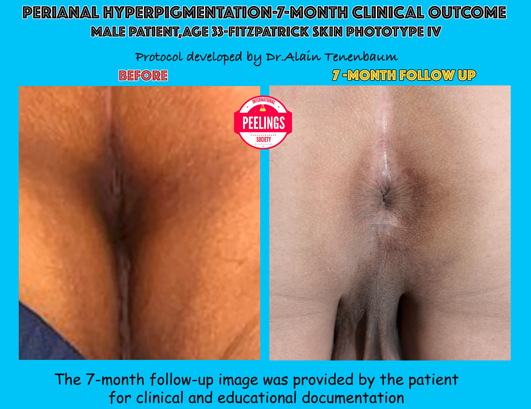 Perianal hyperpigmentation before treatment and after seven months