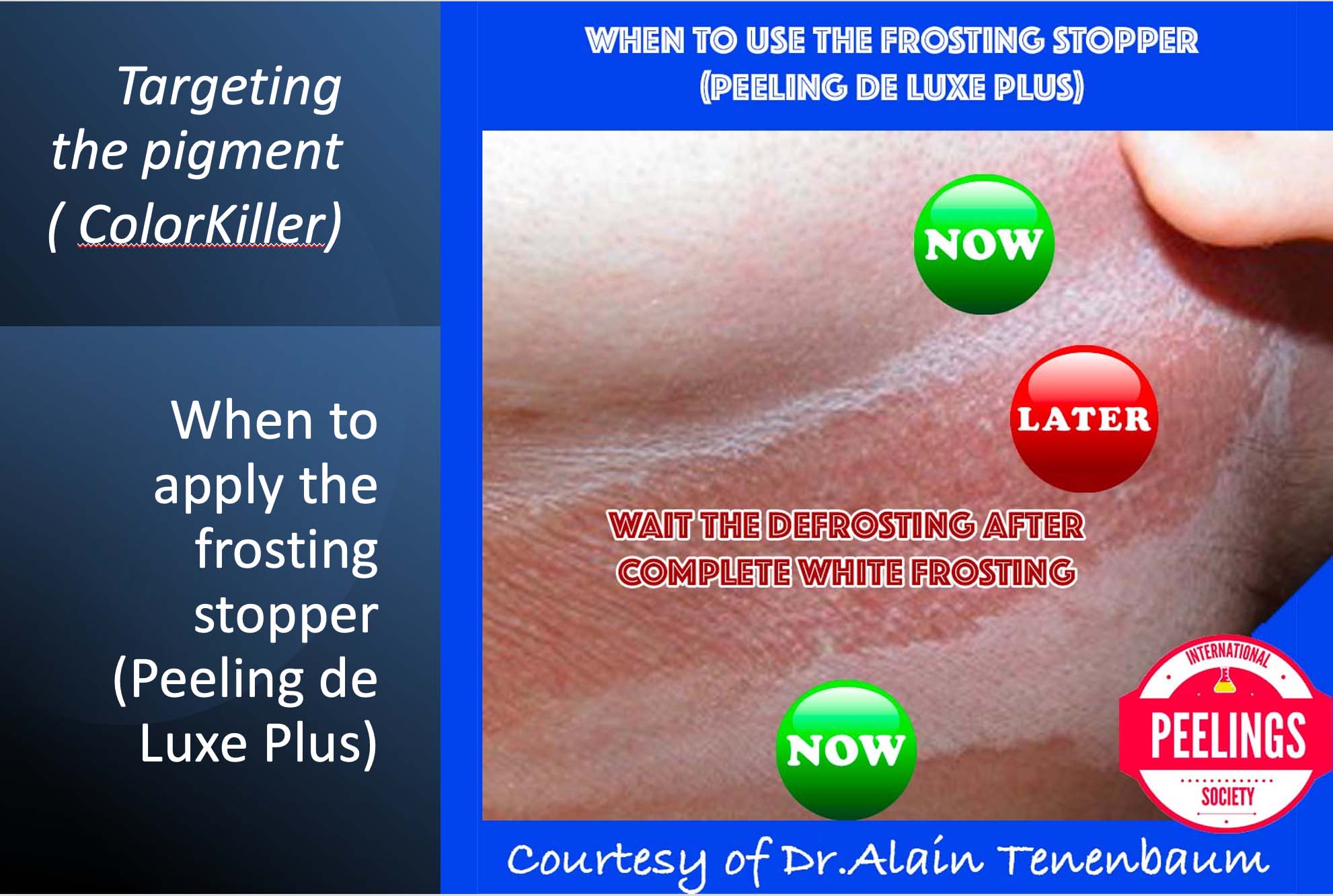 when to apply the frosting stopper peeling de luxe 