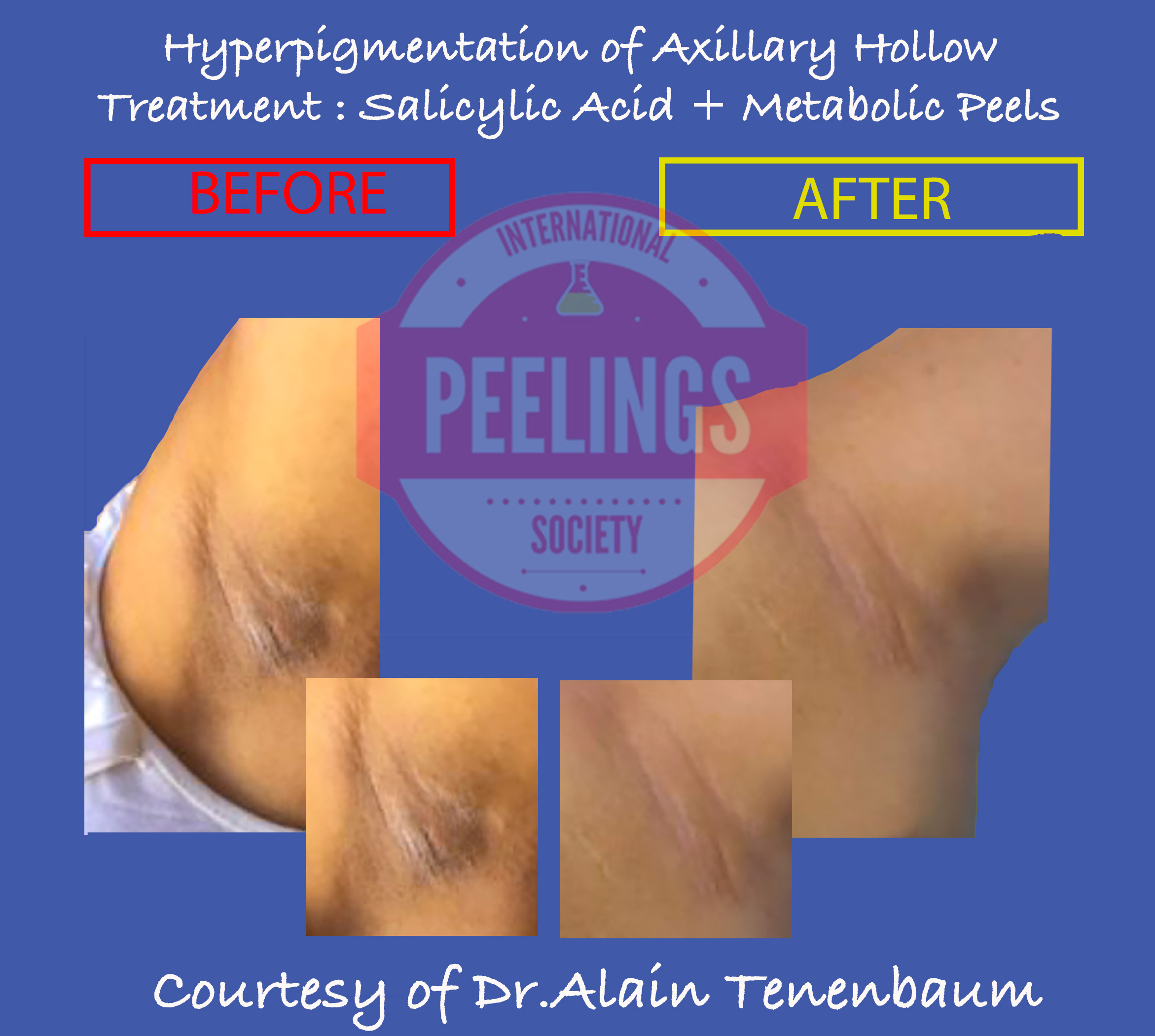 axillary-hyperpigmentation