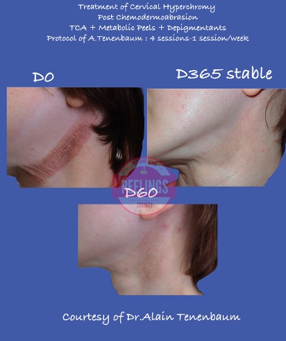neck-hyperchromy-1y-profile