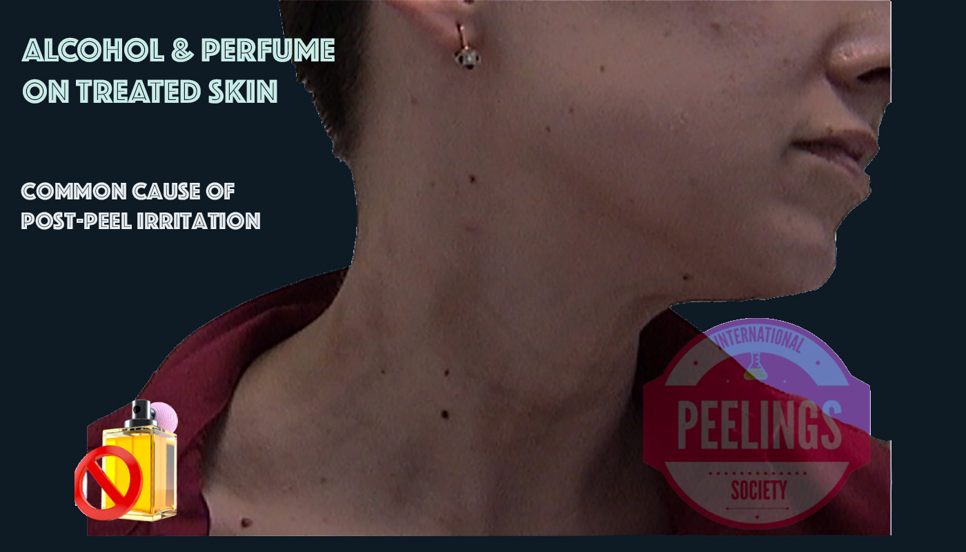 Alcohol/perfume on treated skin can trigger irritant reactions