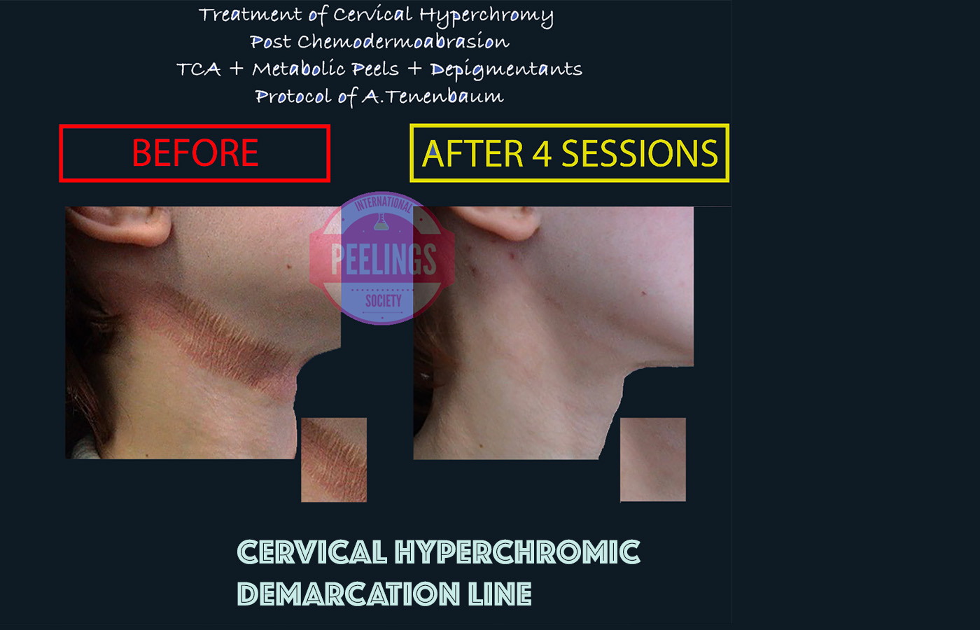 Cervical hyperchromic demarcation line before and after multi-session protocol