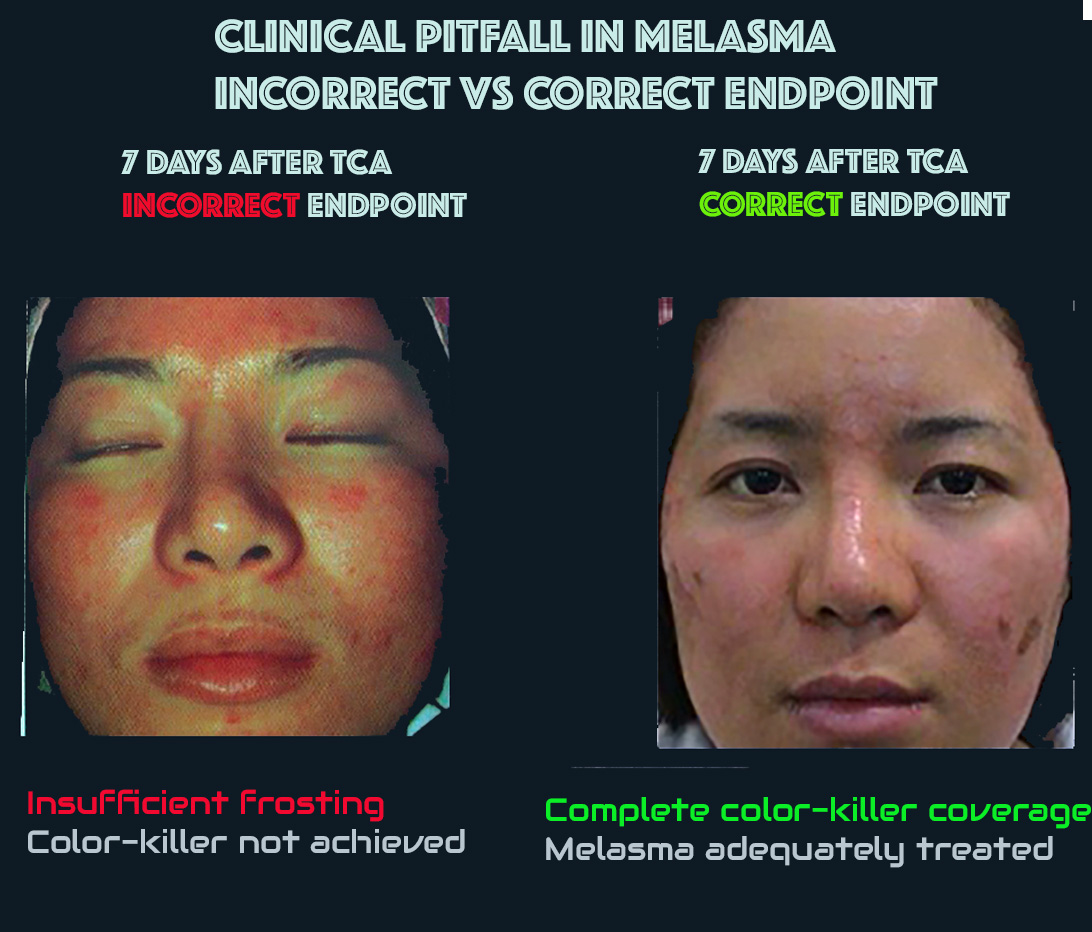 Clinical pitfall: frosting covering melasma may reflect incorrect treatment strategy