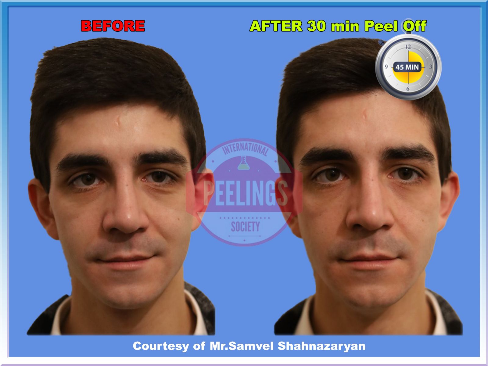 smokers-skin-30minpeeloff-front