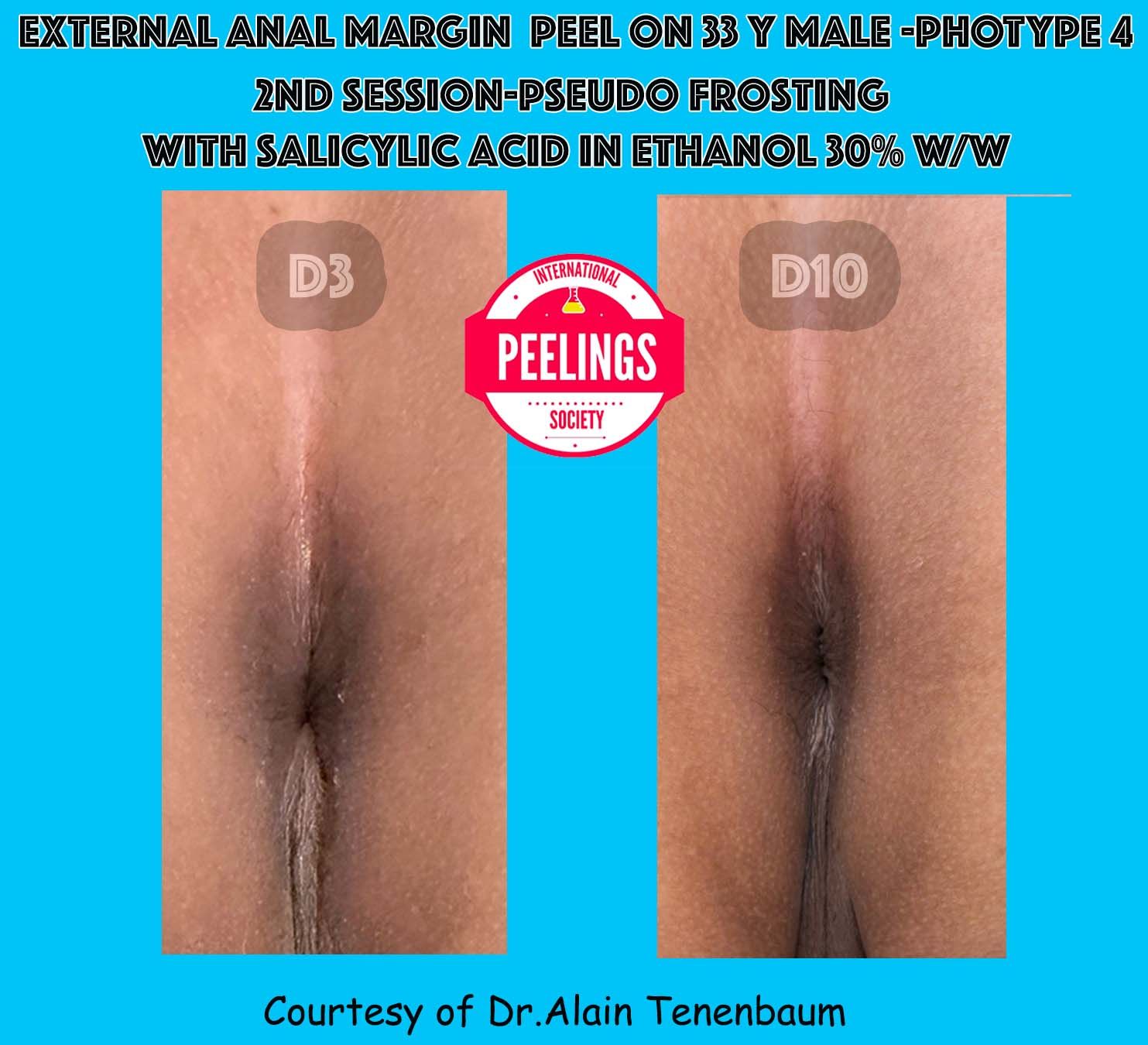 protocol-perianal-area/D3-D10.  2nd session