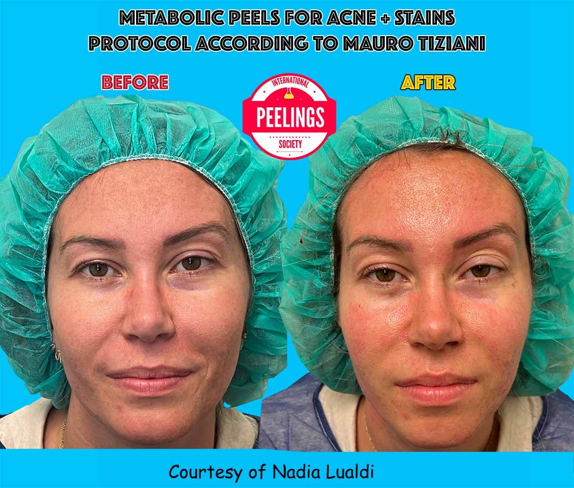 acne-lualdi-front