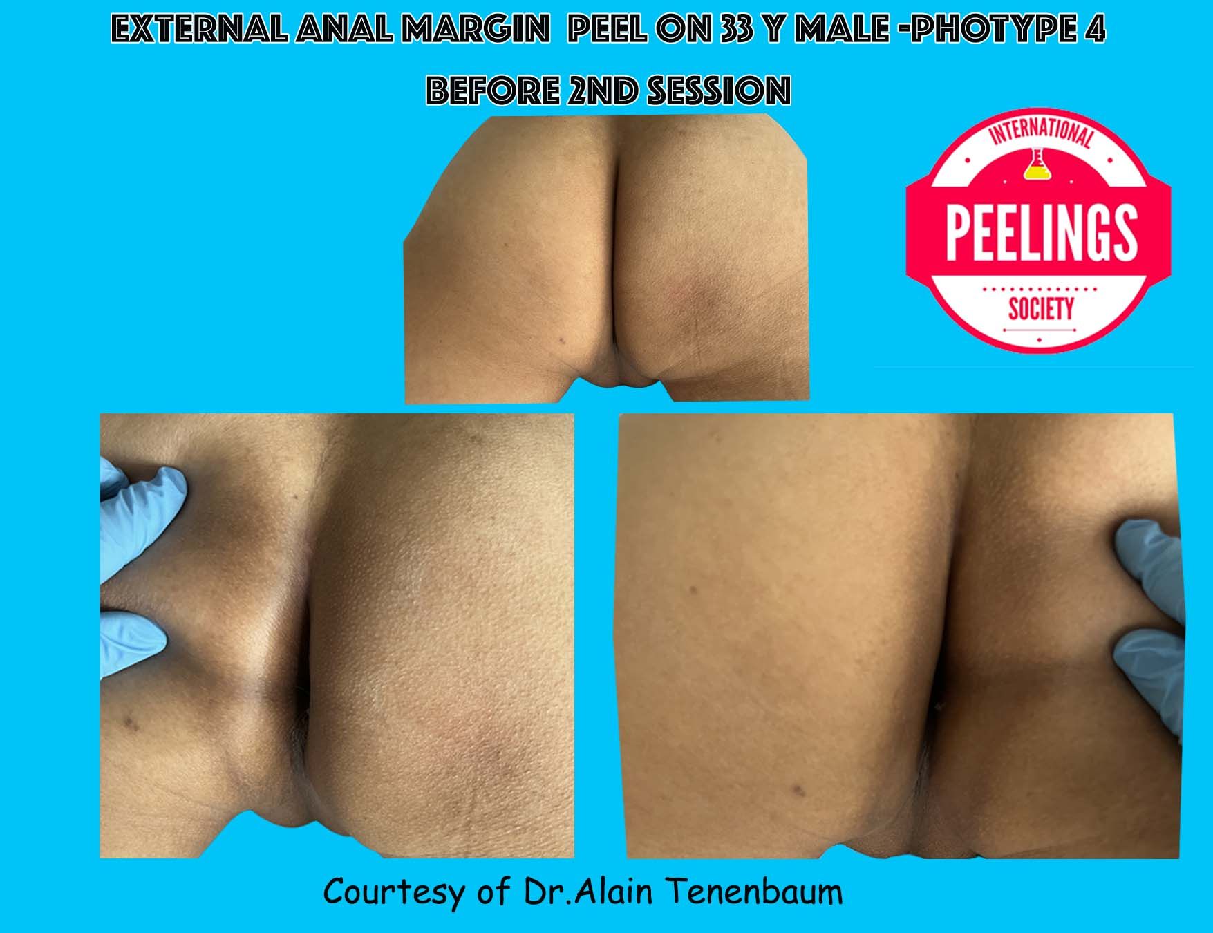 protocol-perianal-area/2nd-session-D0.