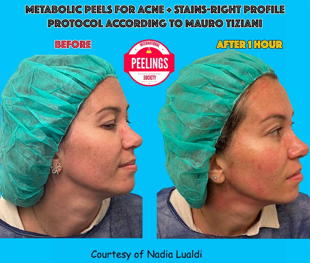 acne-lualdi-profile