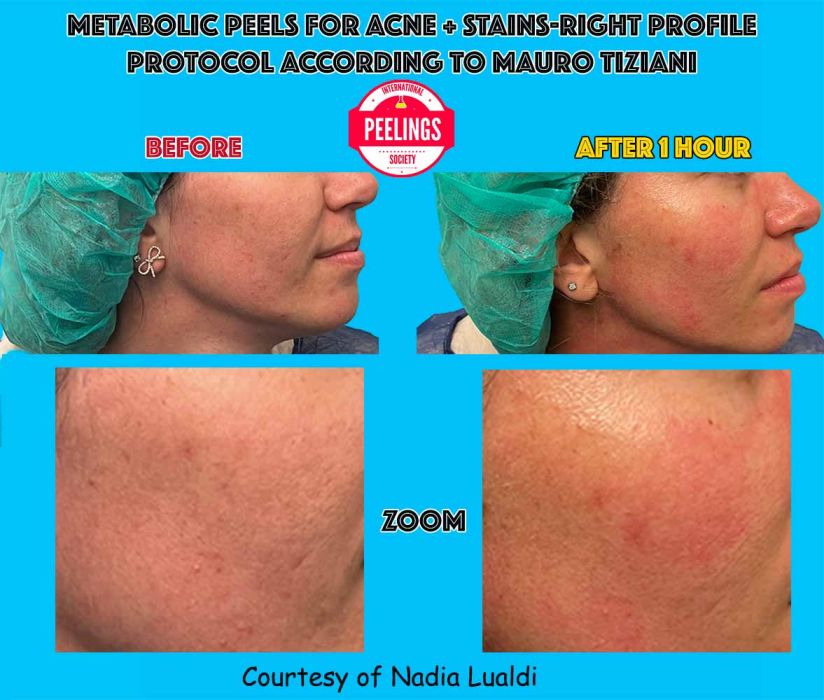 zoom-lualdi-profile-acne