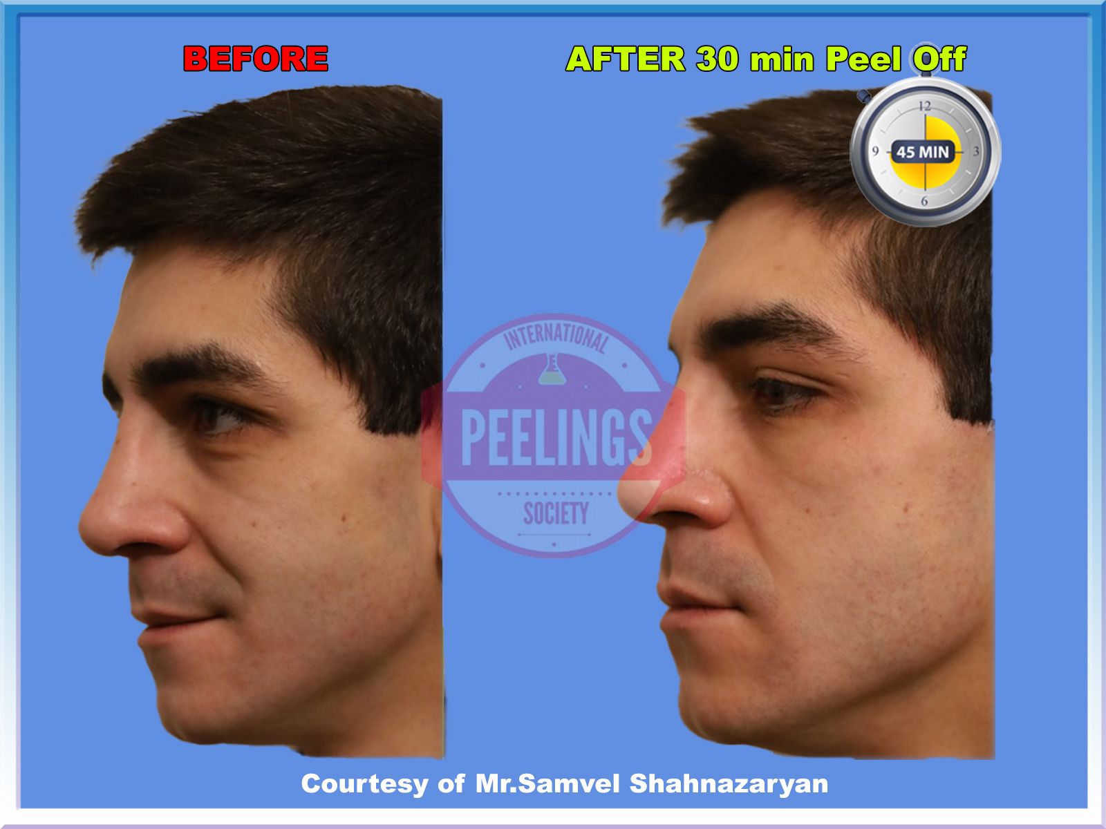 smokers-skin-treatment-pic3