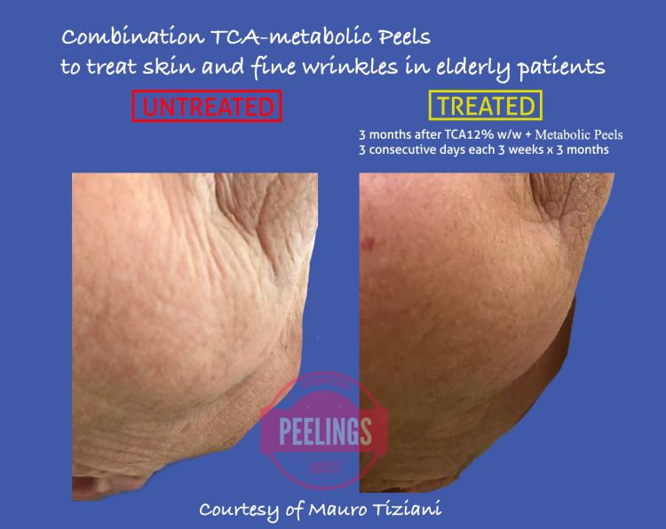 fine-wrinkles-metabolicpeels